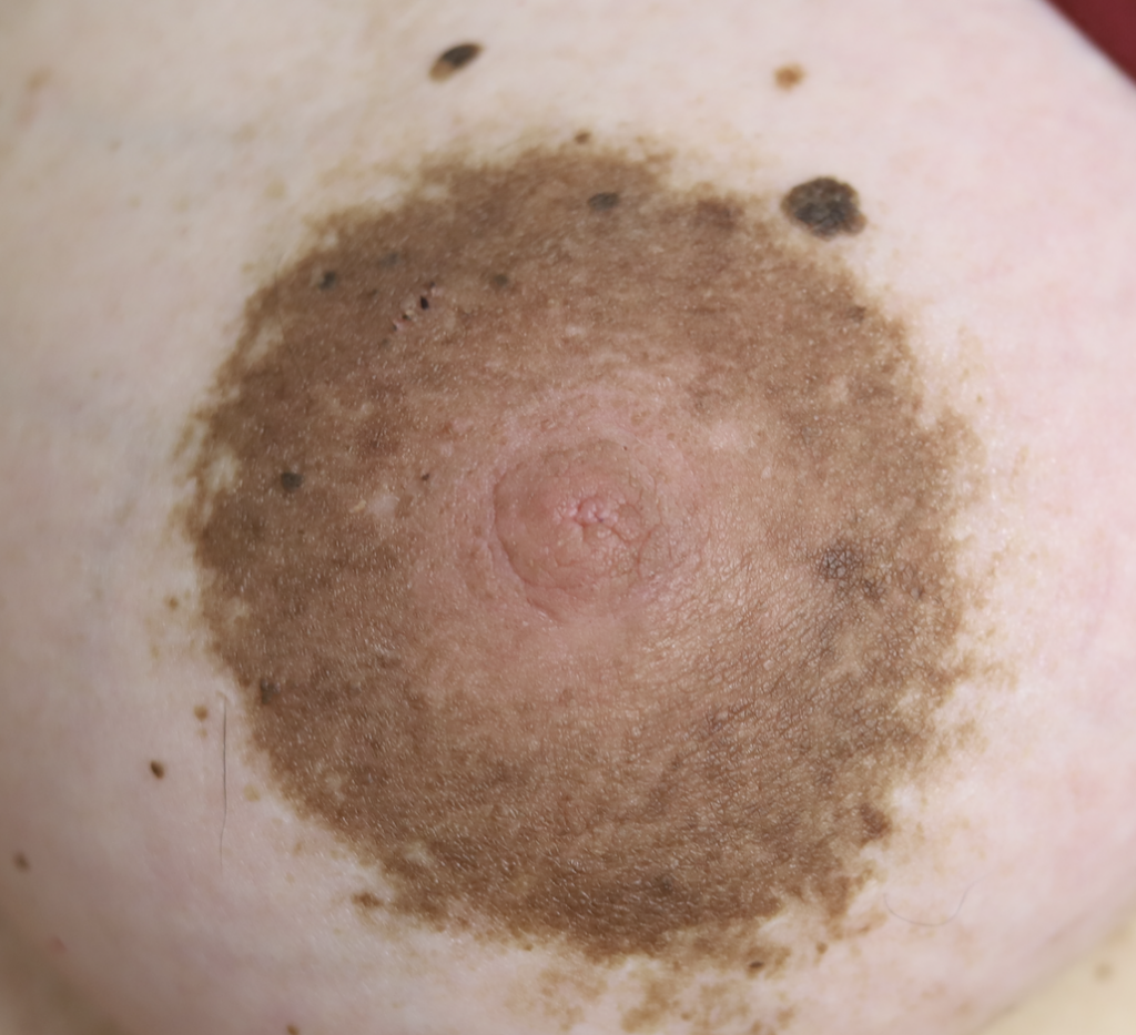 "Flat" nipple