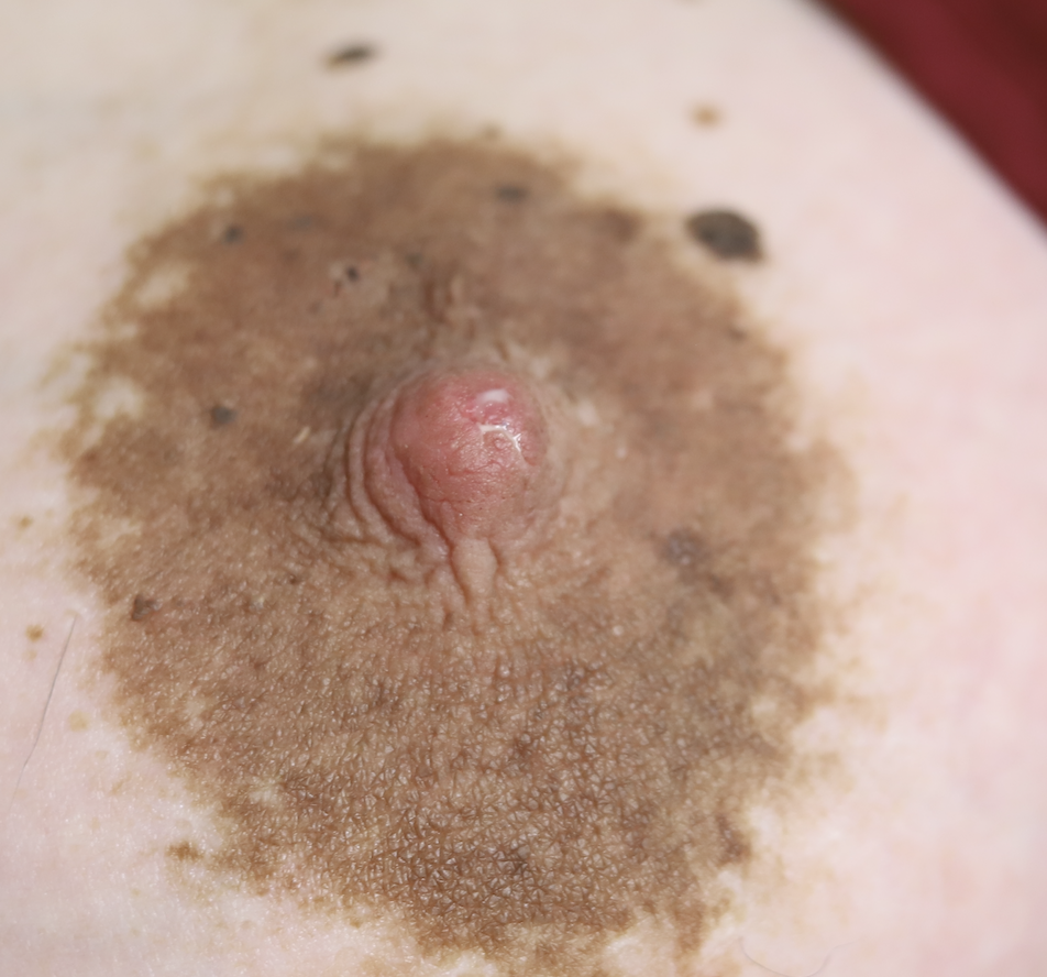 "Flat" nipple not flat!