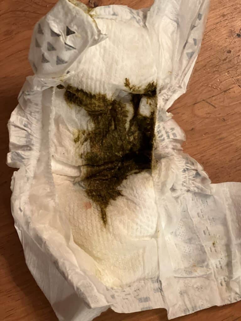 Meconium with urate crystal