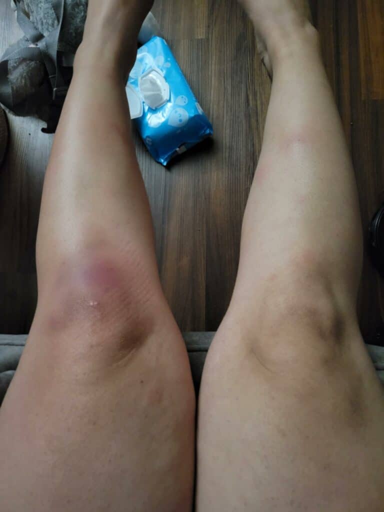 Erythema nodosum in IGM