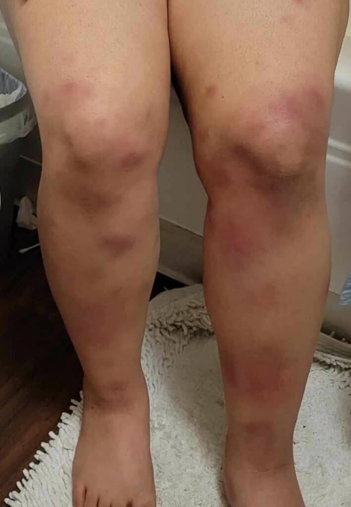 Erythema nodosum in IGM