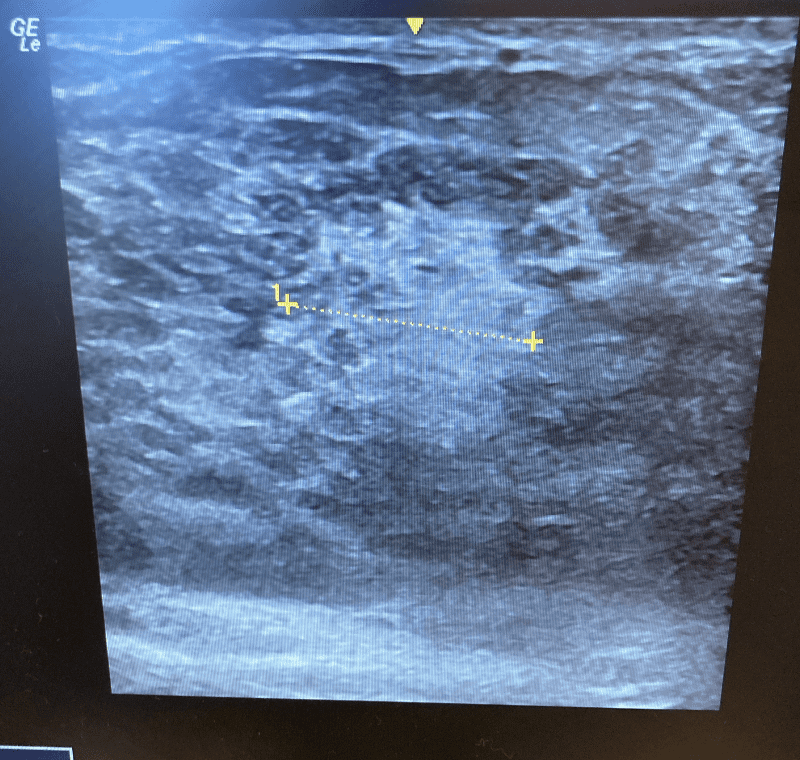 "Plug" or "Lactational Inflammatory Nodule" (LIN)