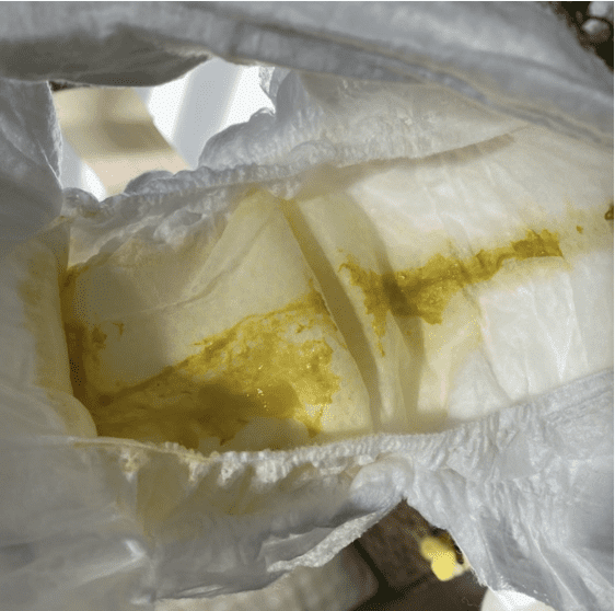 Watery mucous stools in hyperlactation