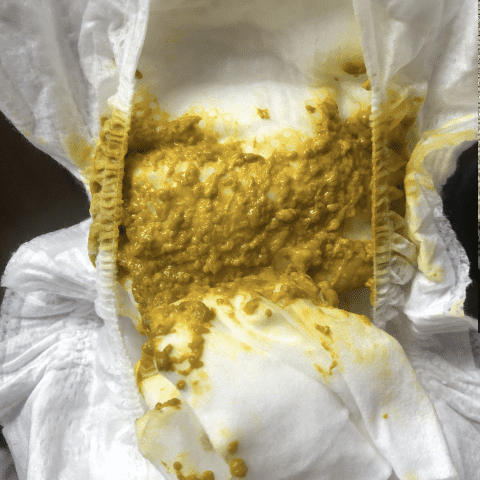 Transition from meconium (black, tarry) to transitional (brownish) to yellow, seedy (mature stool)