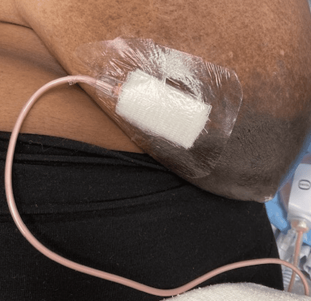 Drain in breast abscess