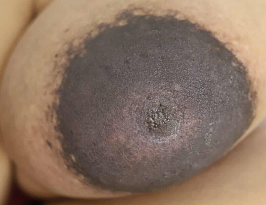 Right nipple lymphedema after major IVF in labor