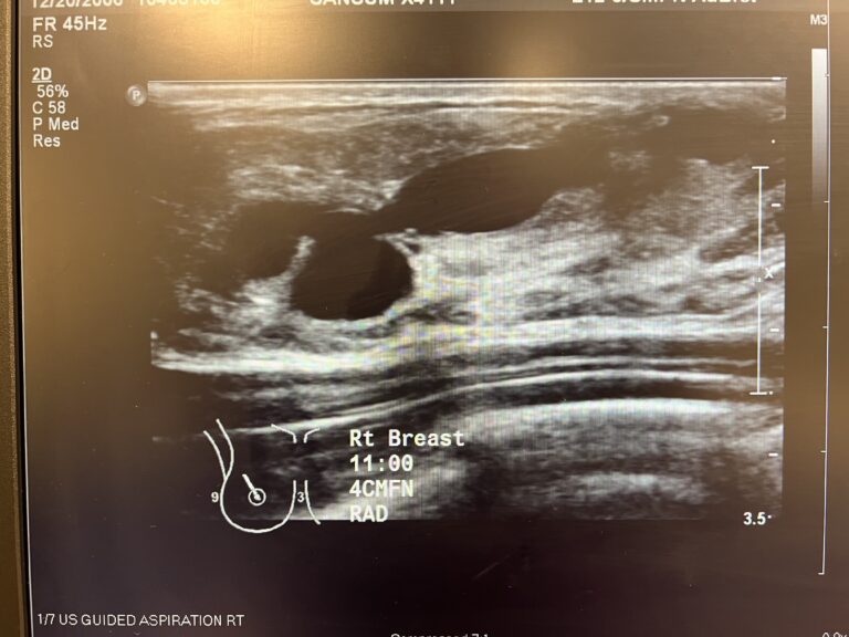 Ultrasound appearance of sebaceous cyst with tract to skin.