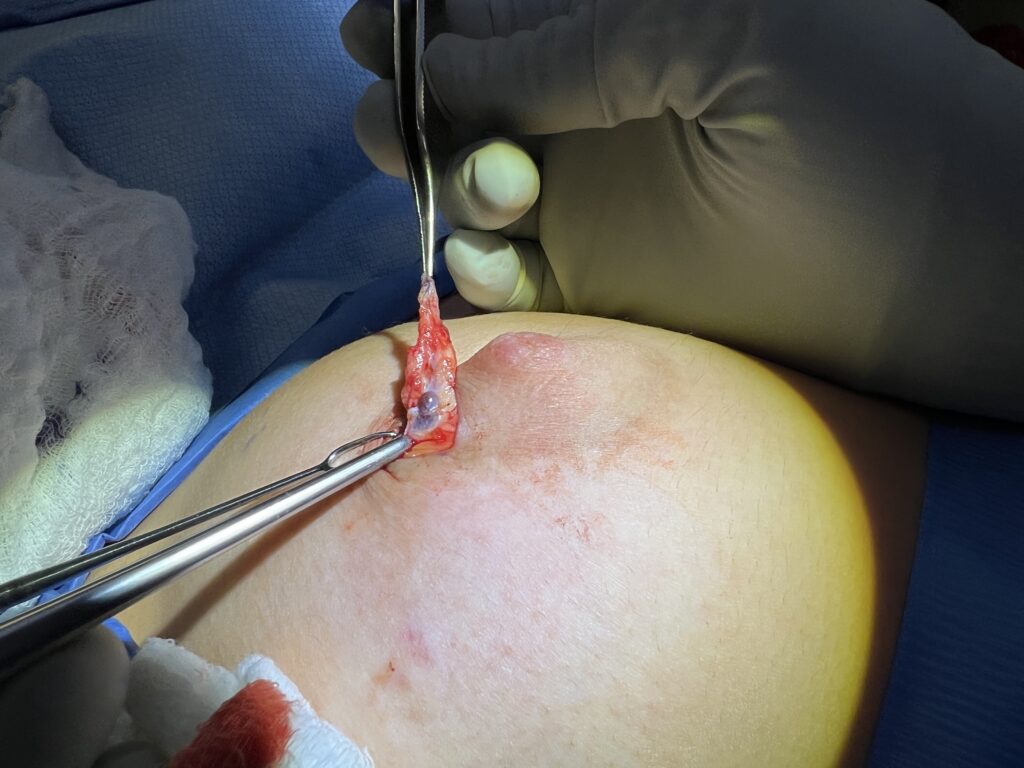 Ductal system connection to Montgomery gland