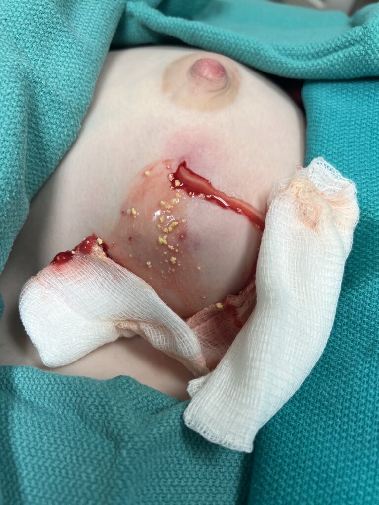 Left galactocele solid milk