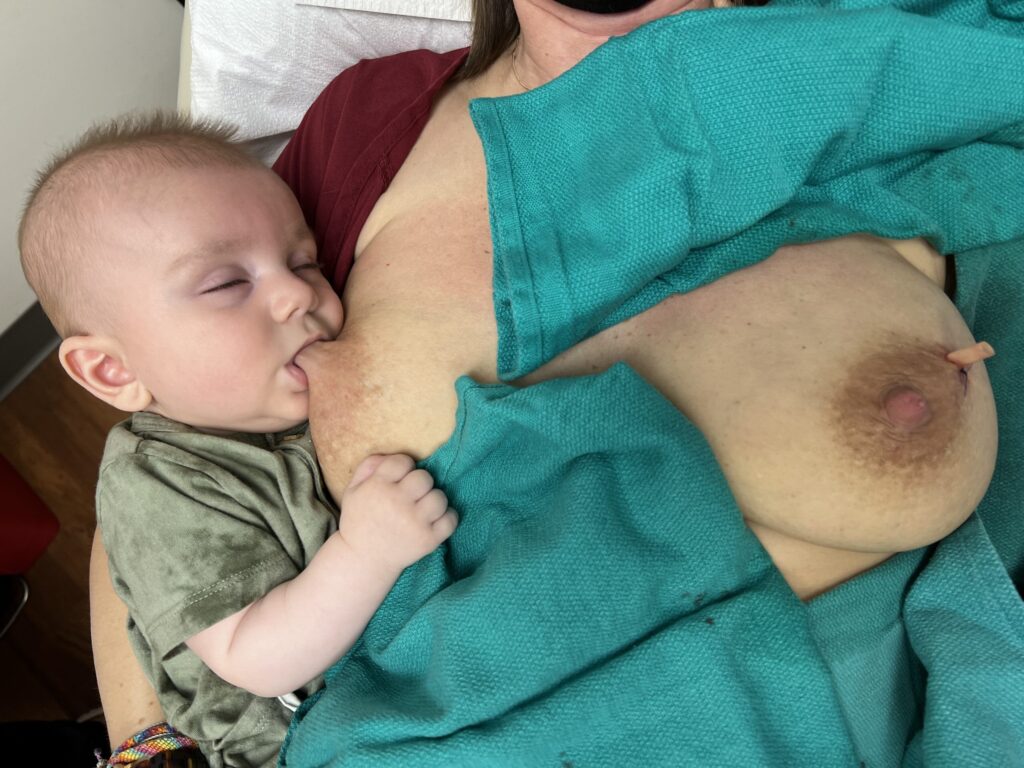 Baby nursing during drainage procedure