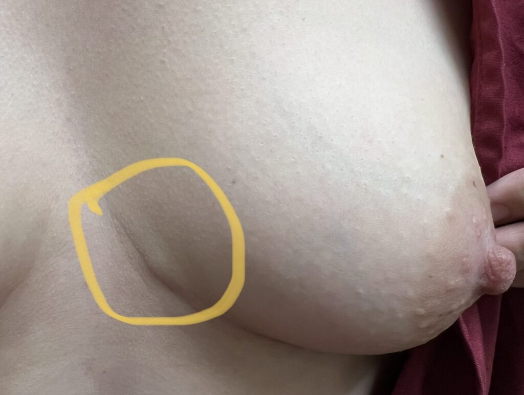 Outside of the nipple, sebaceous cysts most commonly occur along the inframammary fold (underside of breast)