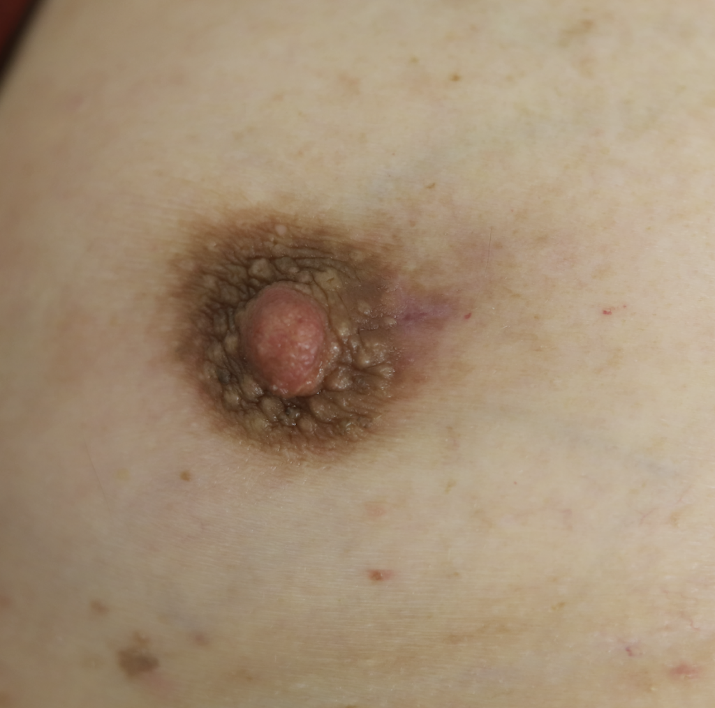 Male periductal mastitis resolved