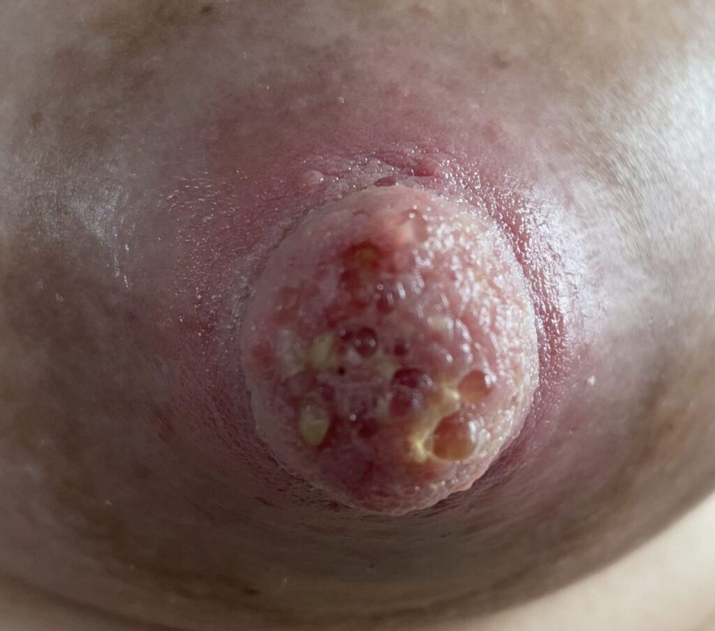 Suction trauma from pump