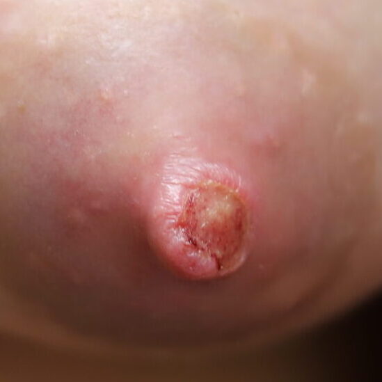 left nipple needs hydrogel not polymem