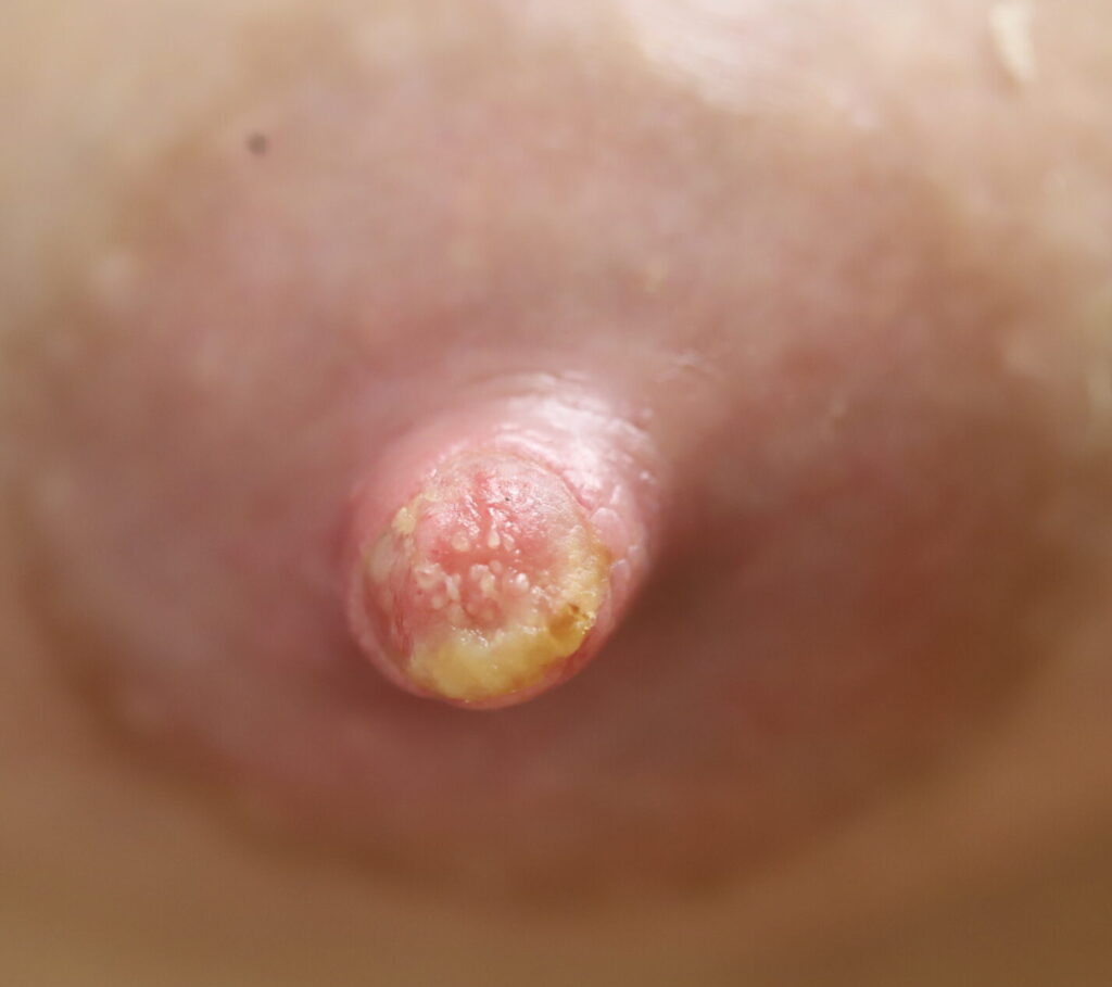 macerated nipples debris not staph