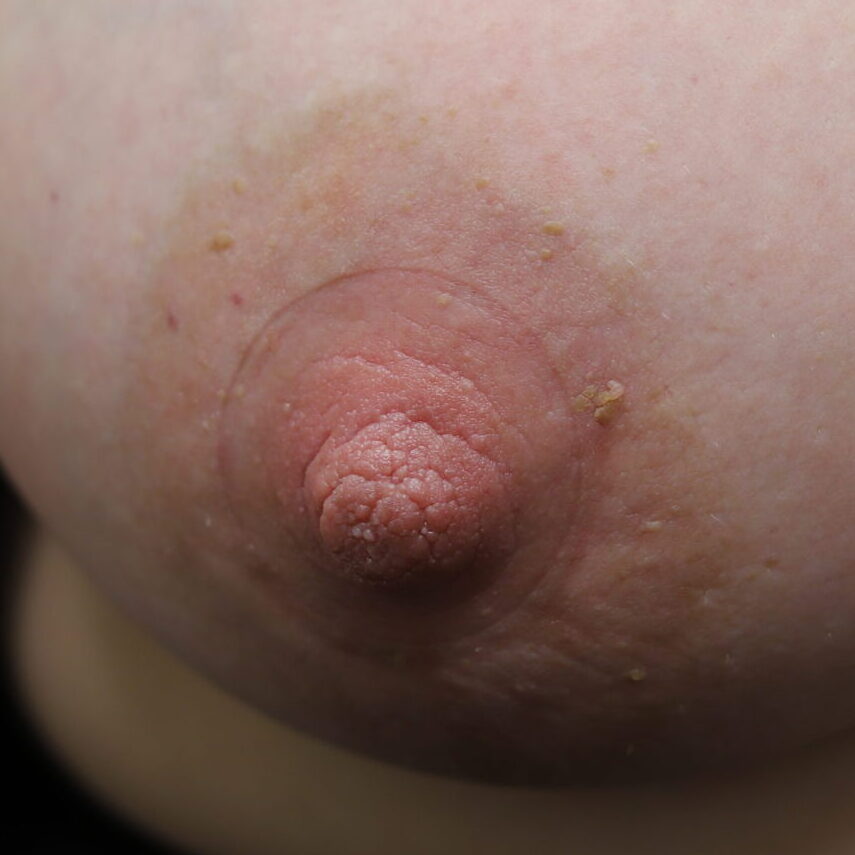 silverette nipple edema right breast