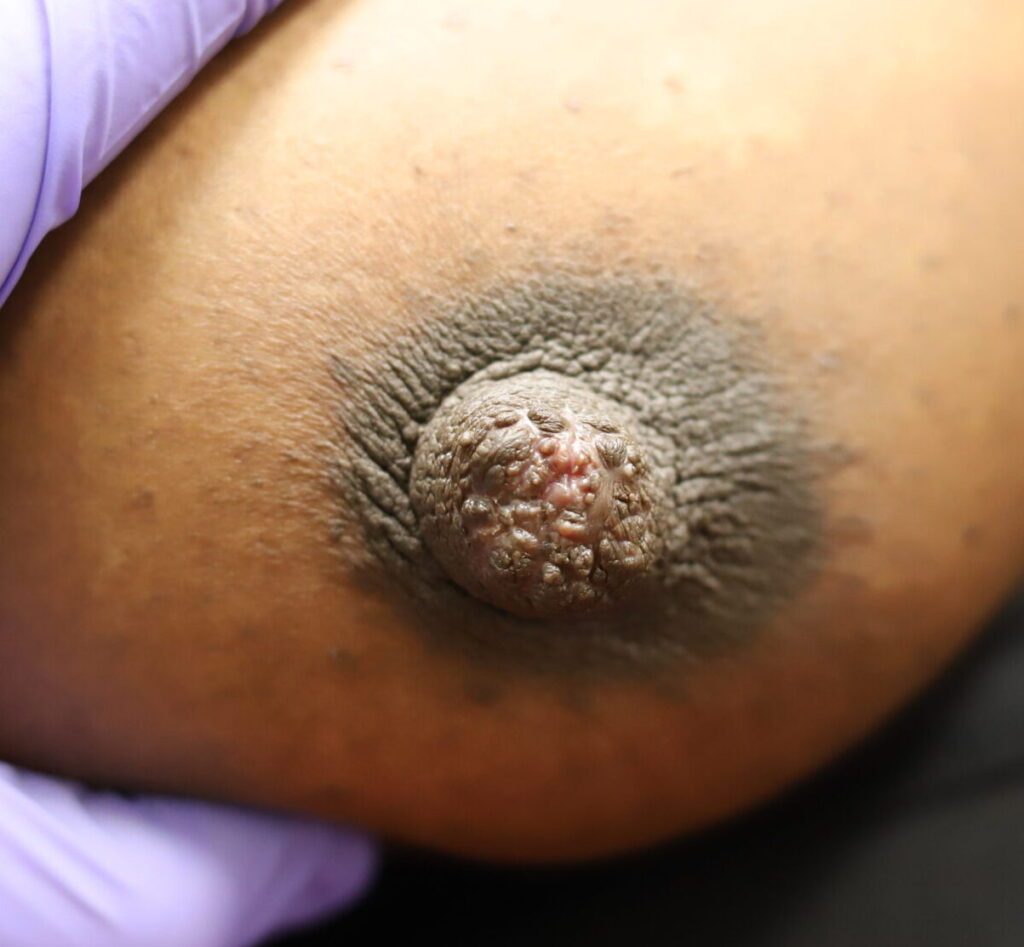 Everted right nipple