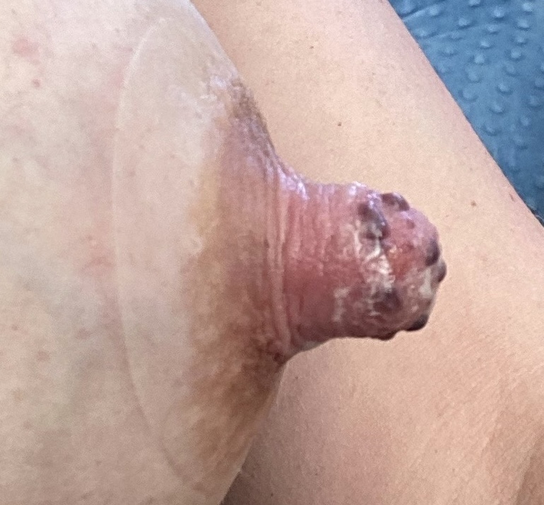 Blood blisters from high suction and small flange