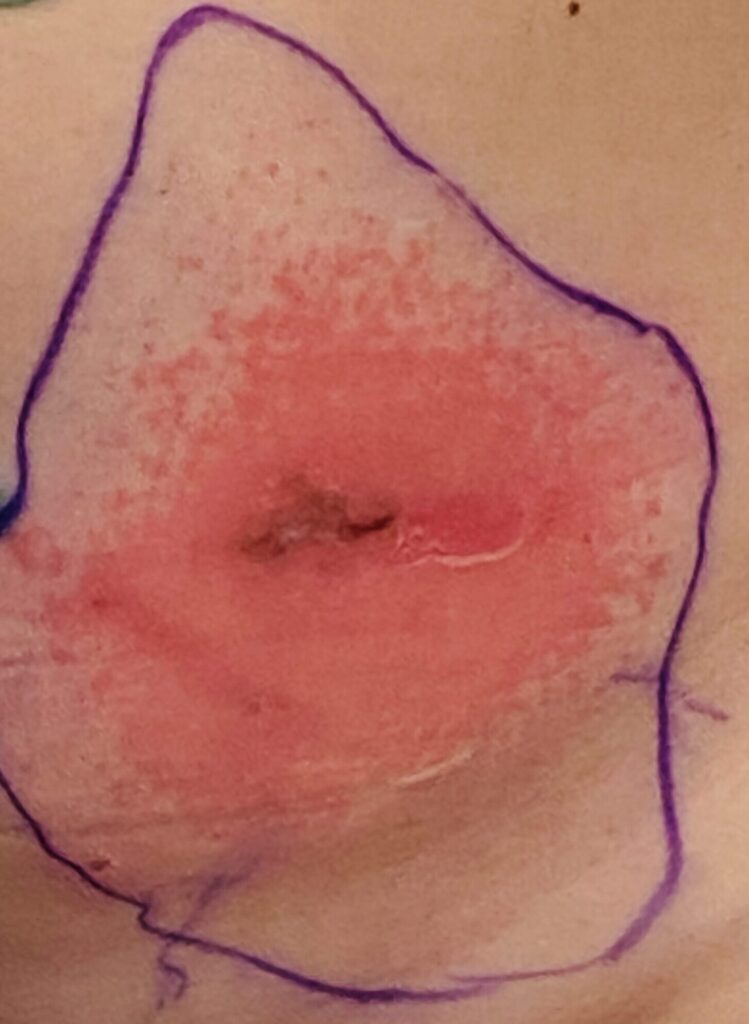 Severe dermatitis, not yeast