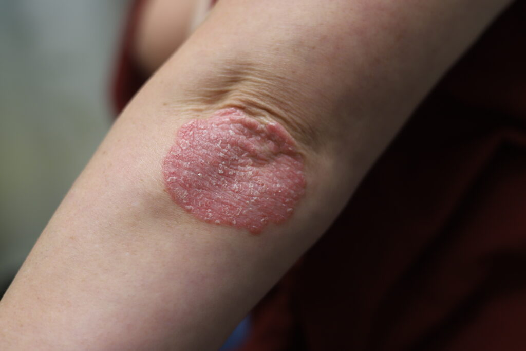 Psoriasis left elbow