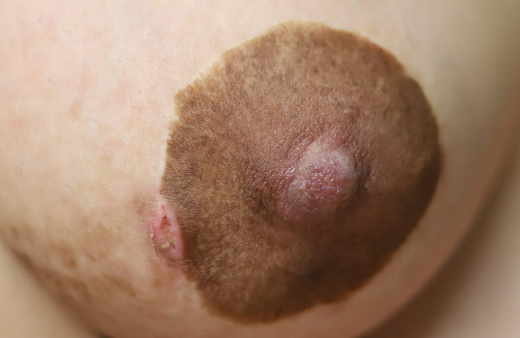 Right areola pump injury