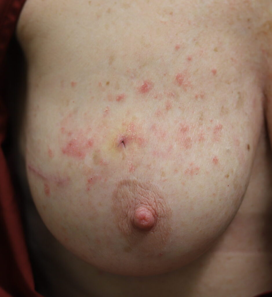 Right breast psoriasis koebernization