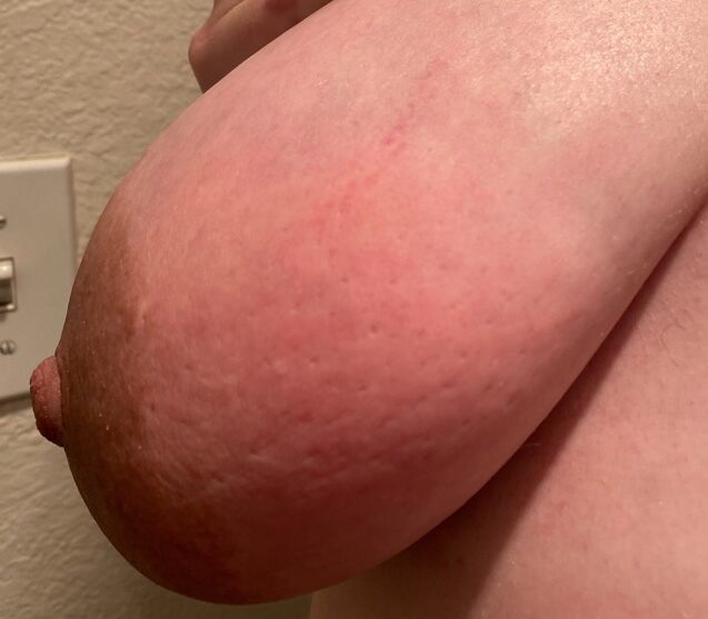 Right breast swelling and redness in pregnancy