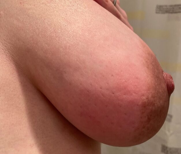 Left breast edema in pregnancy