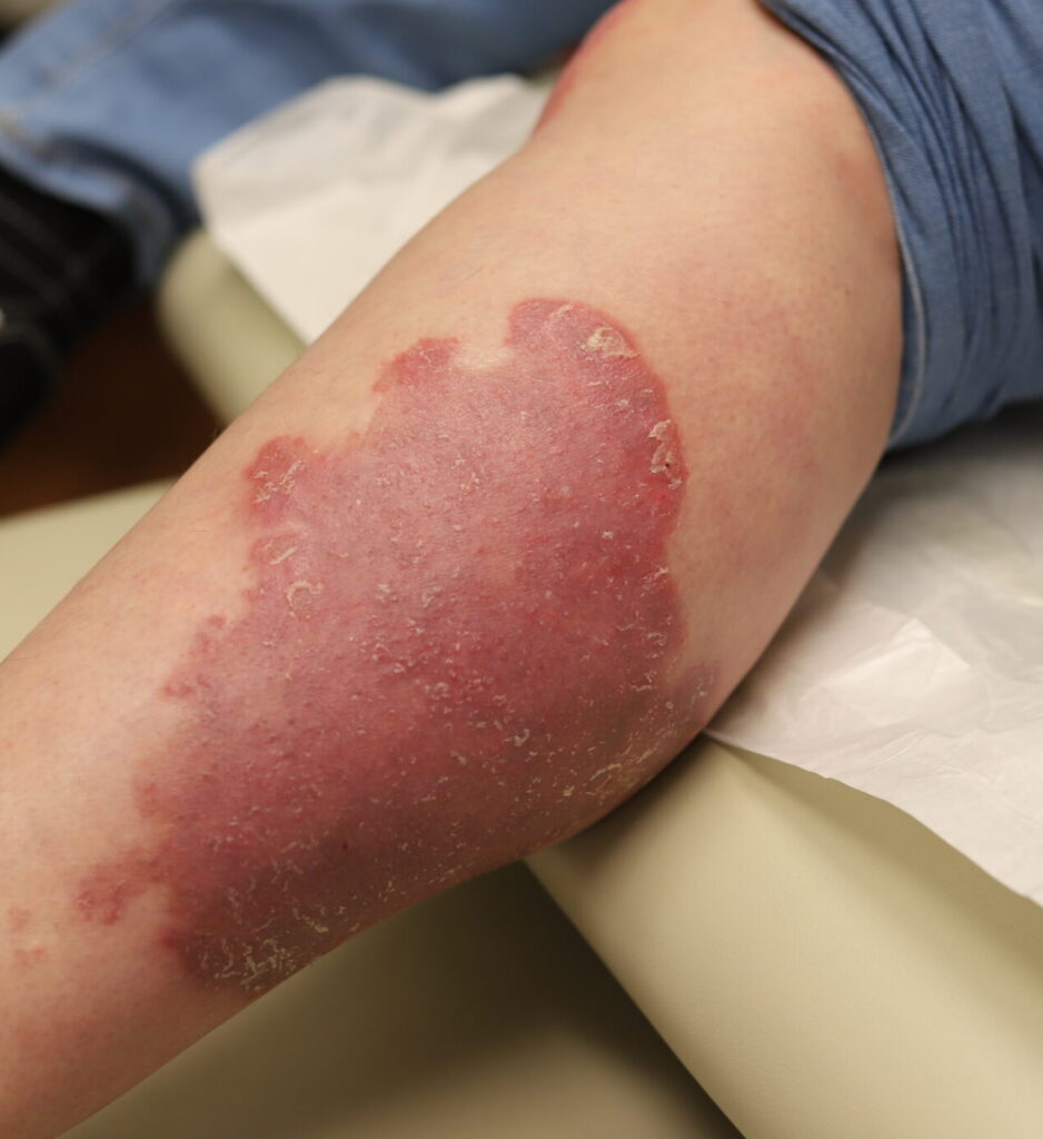 psoriasis left leg scaled e1660176640517