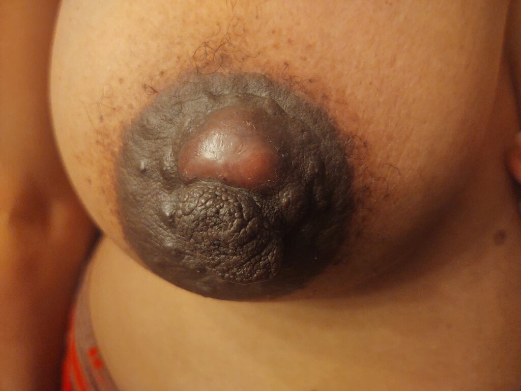 Obstructed montgomery gland