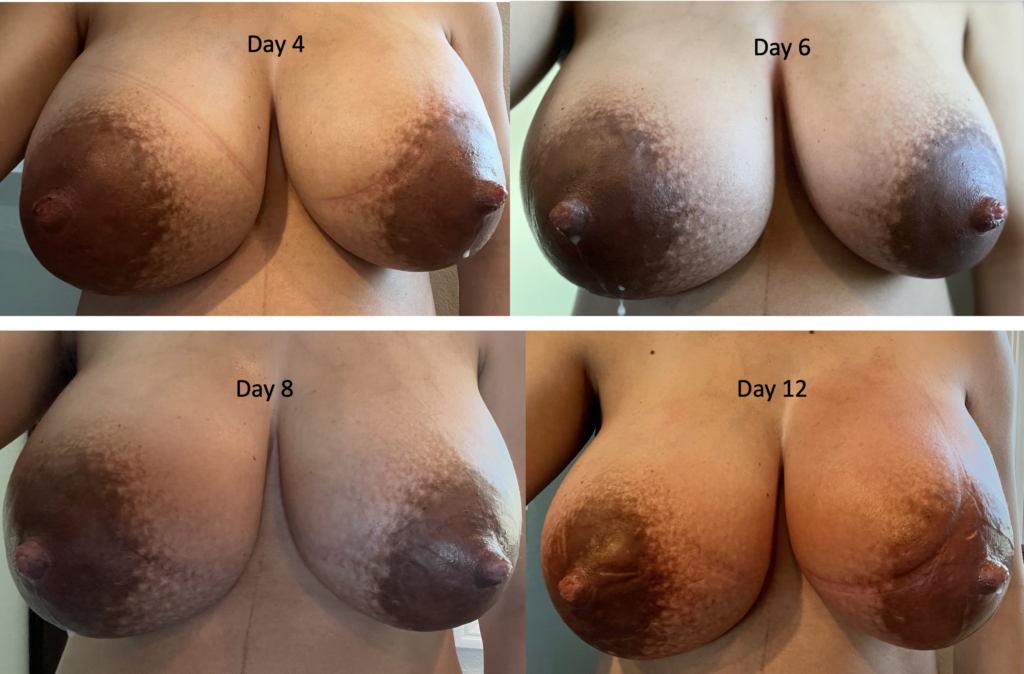 extreme engorgement postpartum