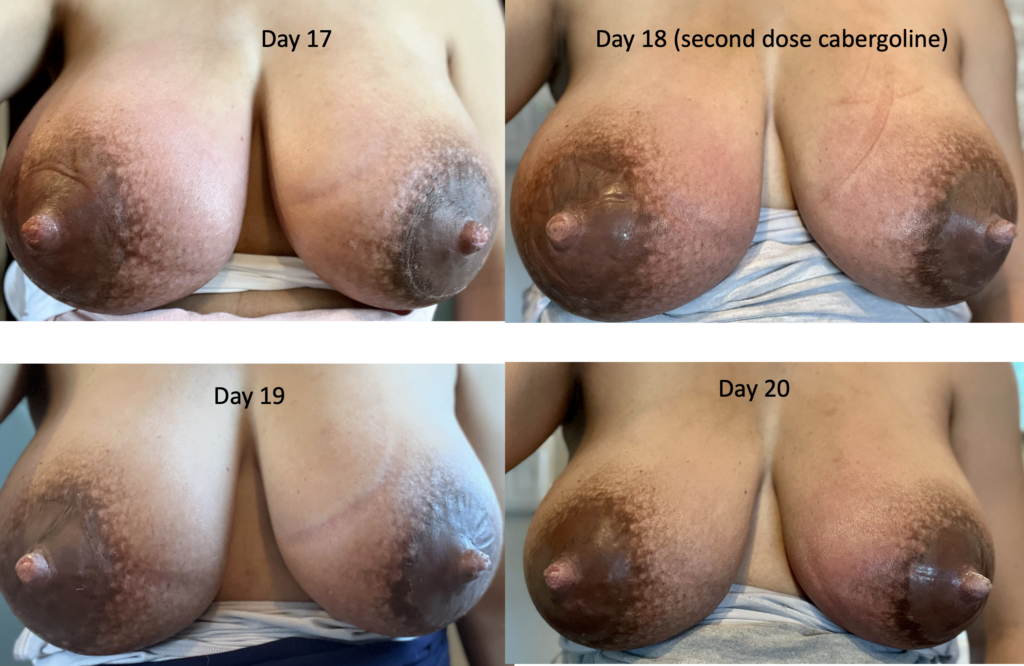 extreme engorgement postpartum