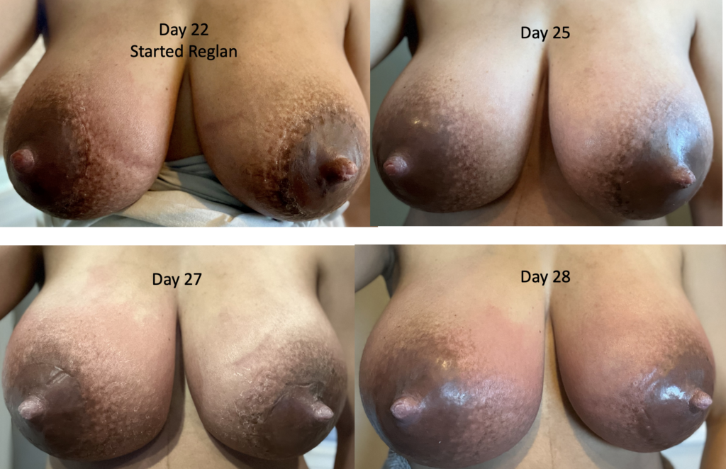 extreme engorgement postpartum