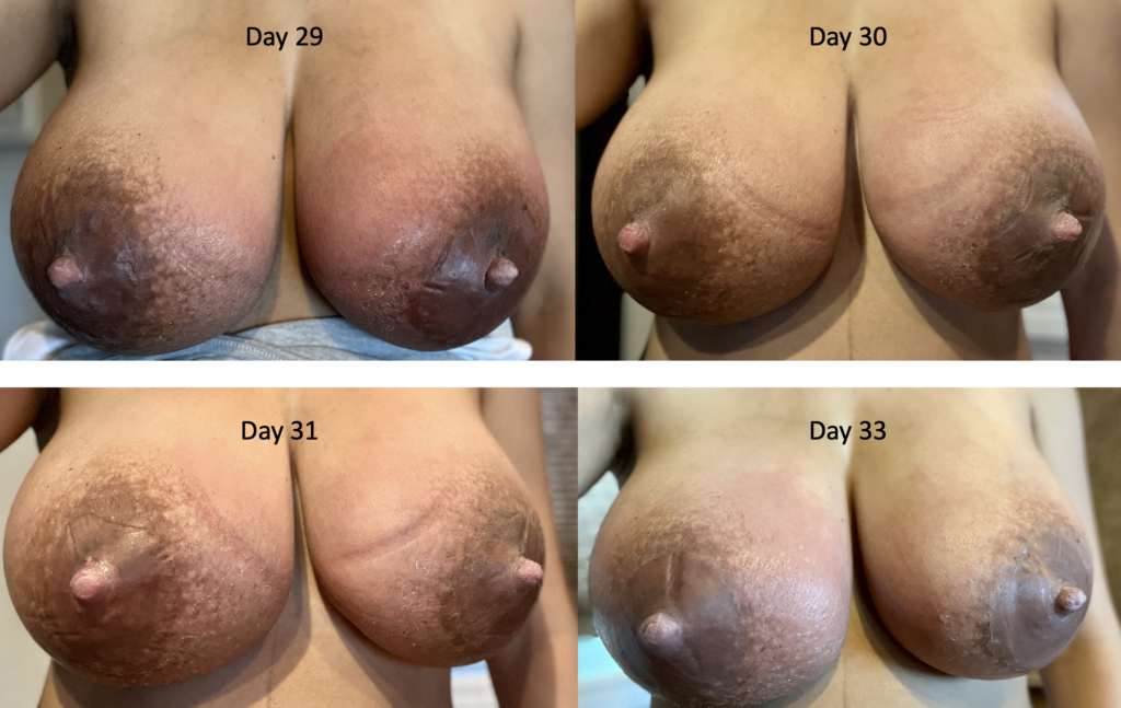 extreme engorgement postpartum