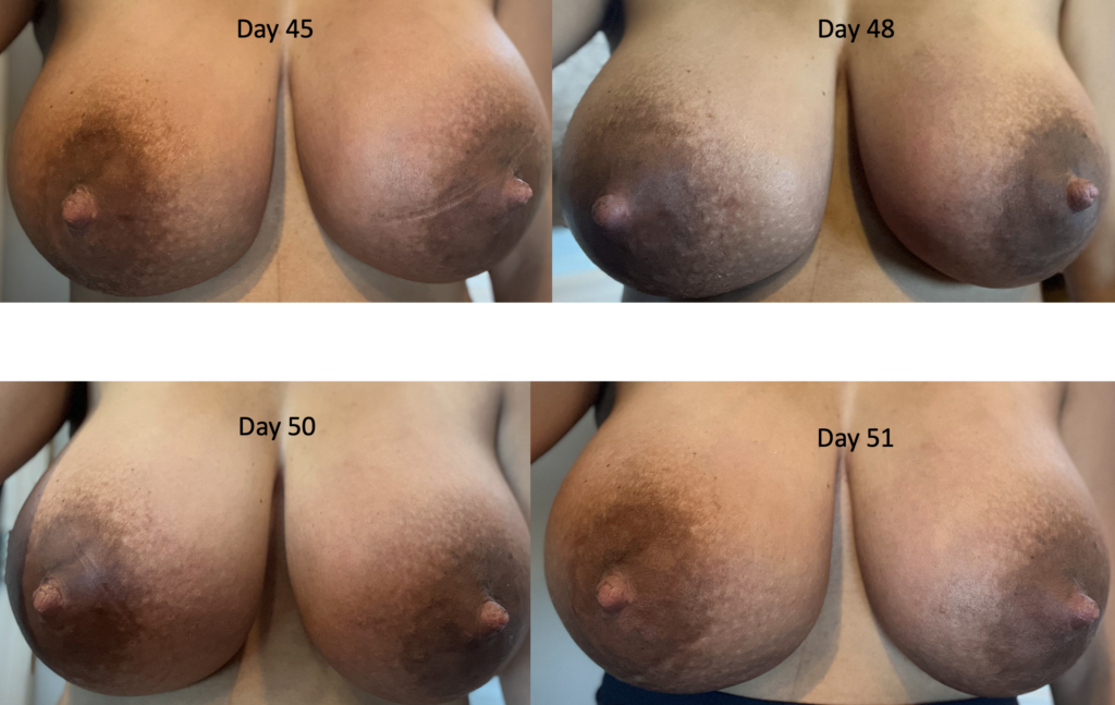 extreme engorgement postpartum