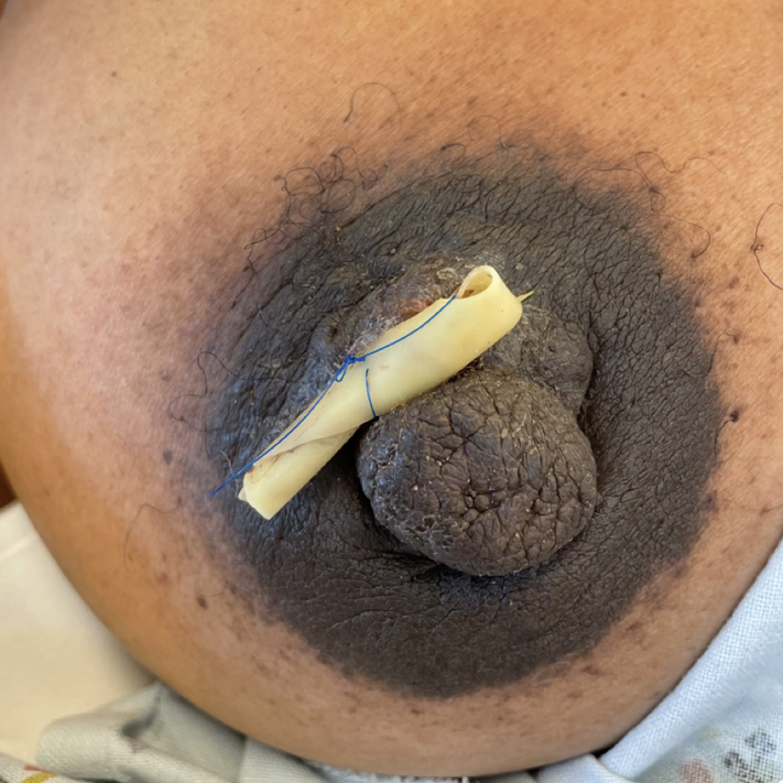 Drained montgomery gland