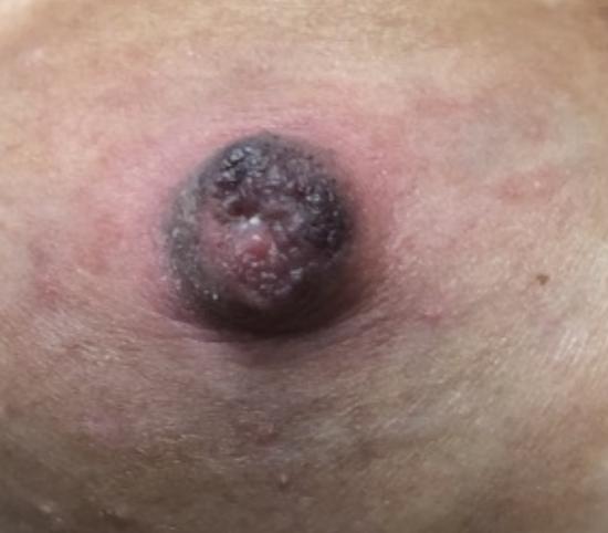 nipple with chronic ischemia from small flanges