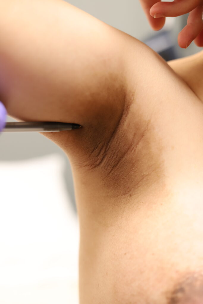 Acanthosis nigricans