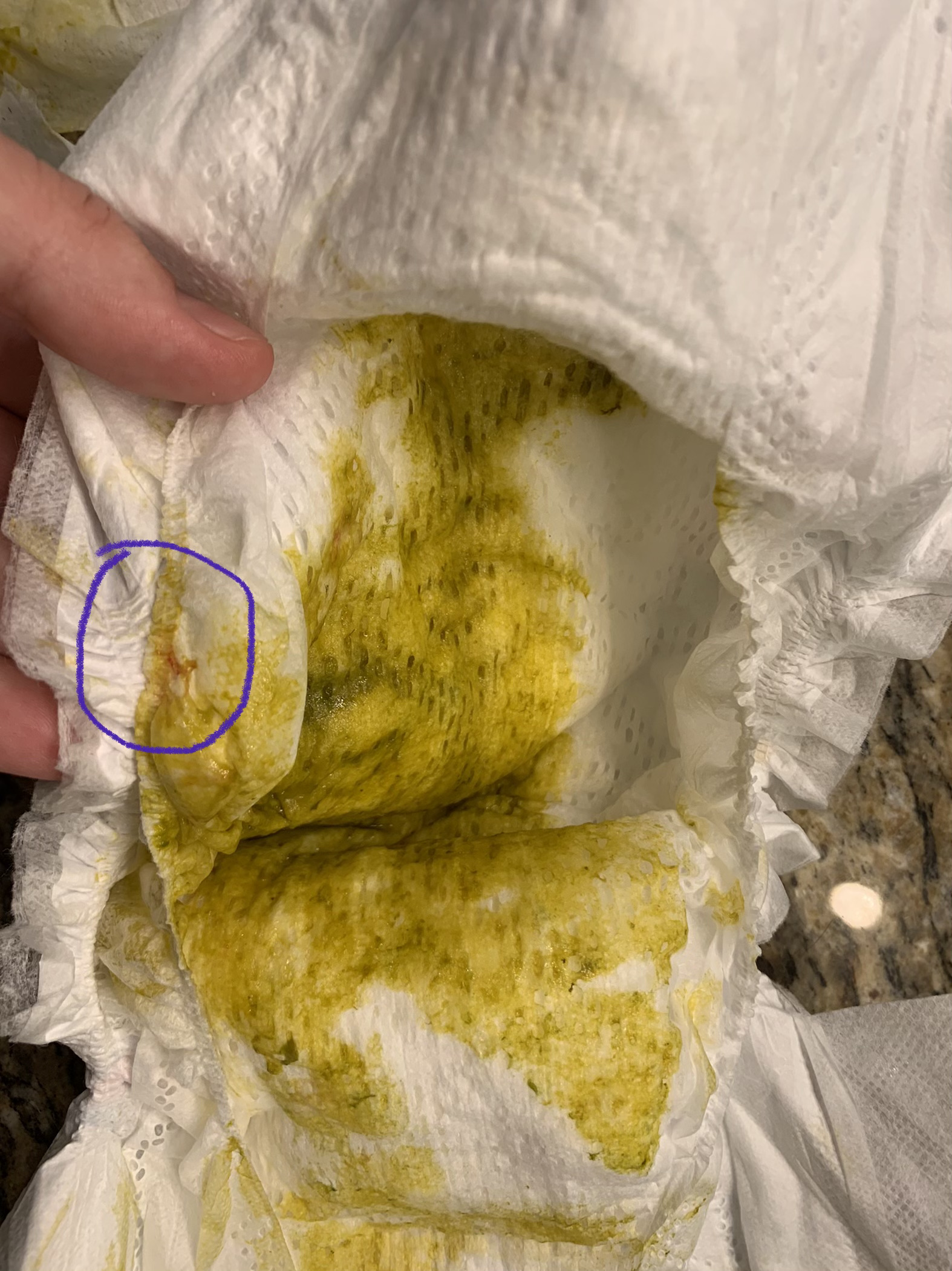 Blood in hyperlactation diaper