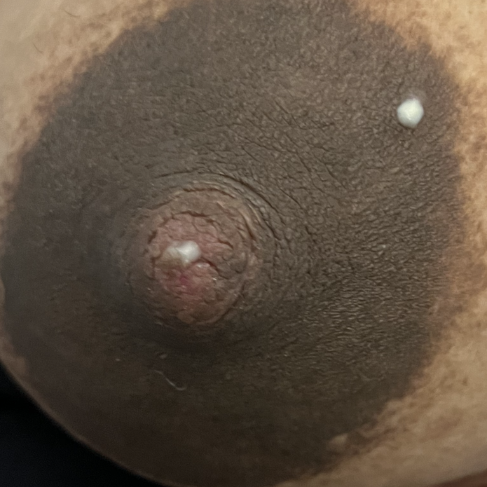 Milk coming from Montgomery gland