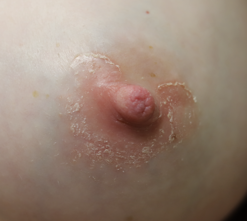 Psoriasis left nipple