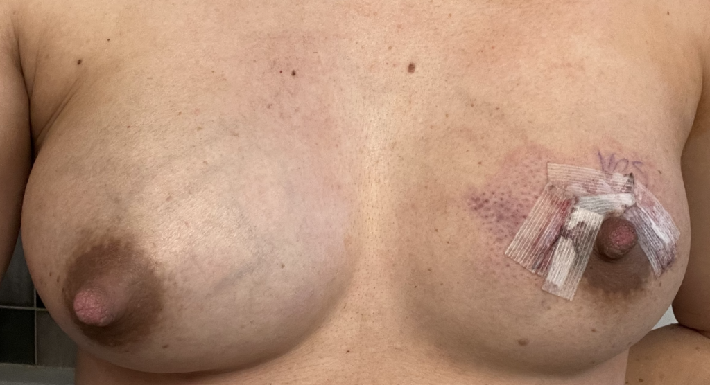 Left breast melanoma