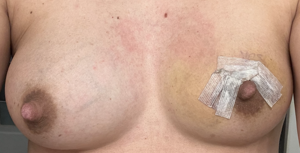 Left breast melanoma