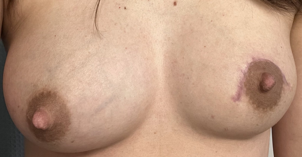 Left breast melanoma