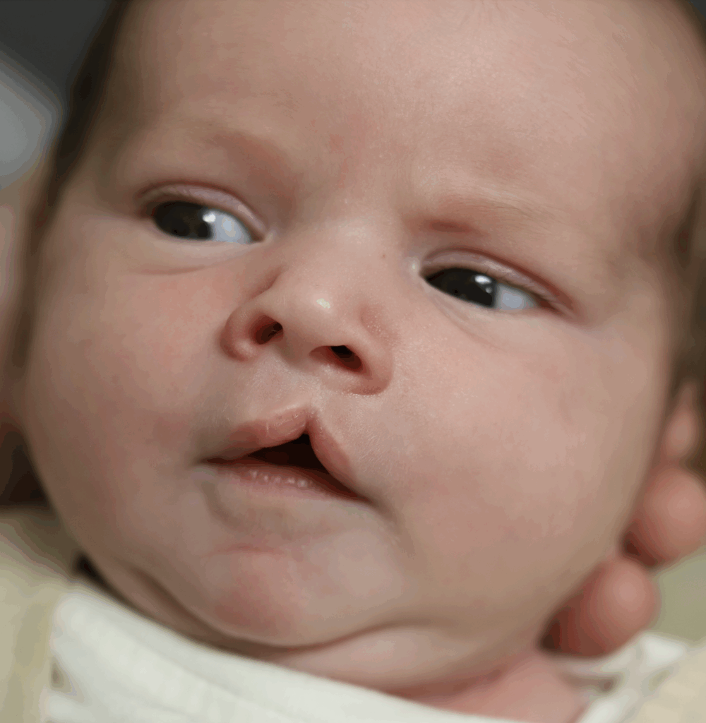 Cleft lip and deviated septum