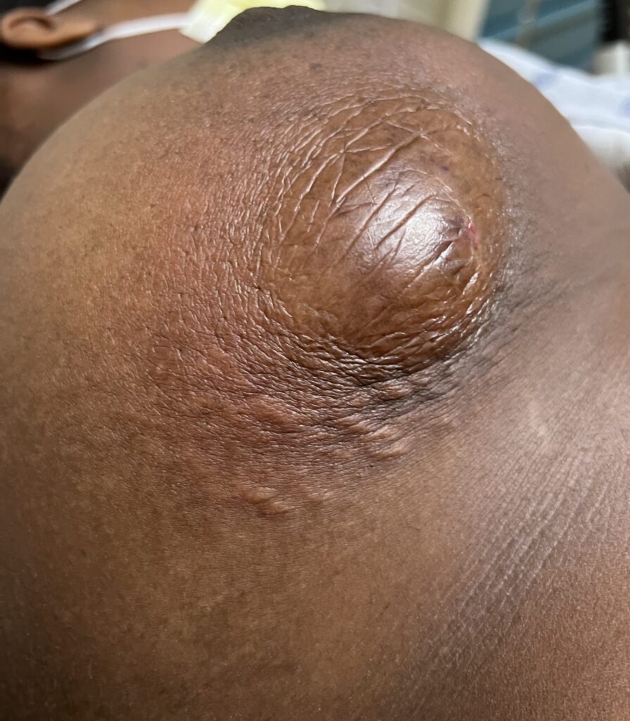 granulomatous mastitis fluid