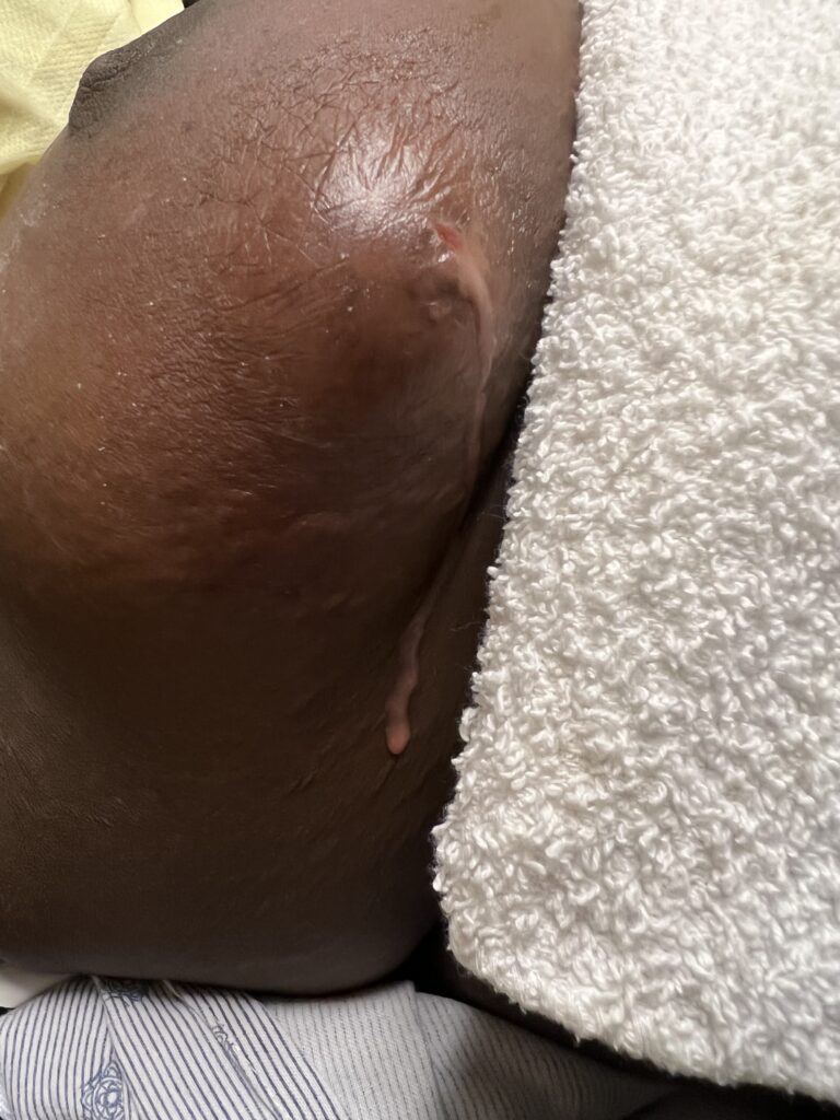 granulomatous mastitis fluid