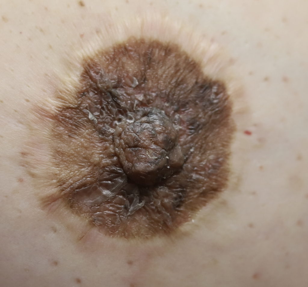 Depigmentation after dermatitis