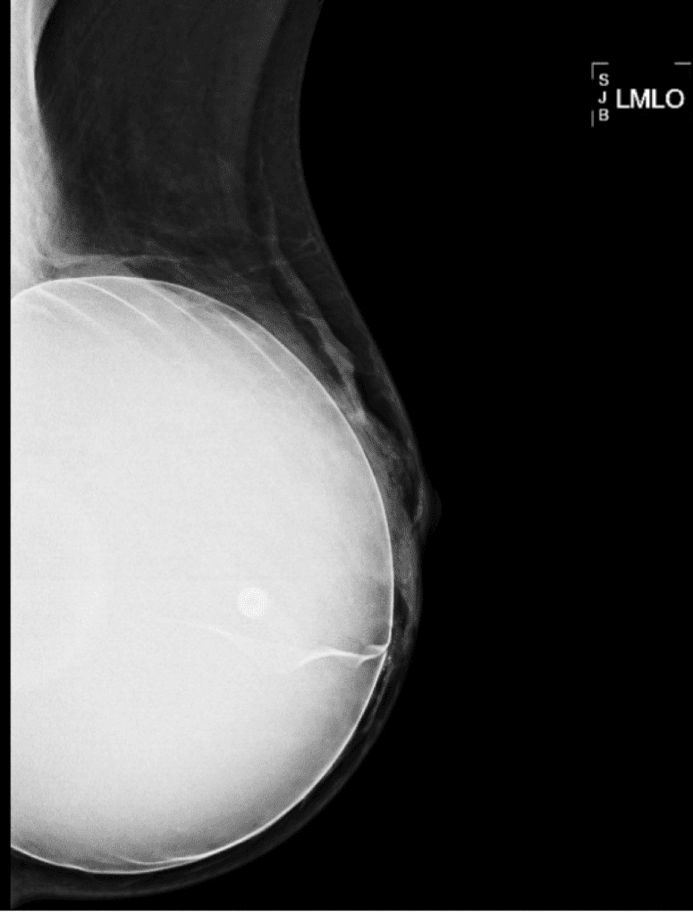 This large implant that a patient had for 10 years shows how the native breast tissue can atrophy (decrease in size/function) over time from chronic pressure.