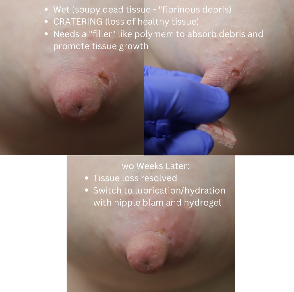 Nipple wound care